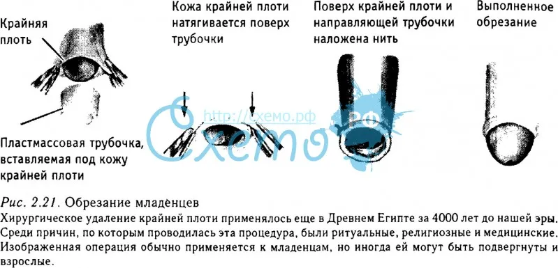 Обрезание крайней плоти для продления полового акта